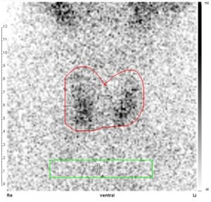 Autoimmunthyreoiditis (beidseits nur geringe Tc-Aufnahme, Tc-Uptake 0,2 %)