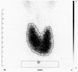 M. Basedow (kräftige, homogene Tc-Aufnahme in beiden Schilddrüsenlappen, Tc-Uptake 3,5 %).