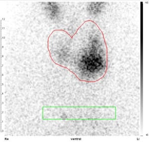 Autonomes Adenom (fokale Mehranreicherung in einem ca. 2 cm großen Bezirk basal im linken Schilddrüsenlappen, Tc-Uptake 0,8 %).
