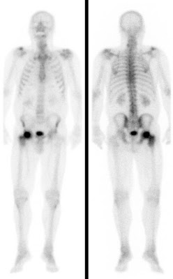 Transiente Osteoporose (Vorstufe einer Hüftkopfnekrose, die durch Entlastung häufig noch verhindert werden kann) bei einem 73-jährigen Mann. Die geringe Mehrdurchblutung sowie der stark vermehrte Knochenumbau im gesamten rechten Hüftkopf einschließlich Schenkelhals und Trochanterenmassiv sprechen stark für das Vorliegen einer transienten Osteoporose. Eine Hüftkopfnekrose scheint noch nicht vorzuliegen (in diesem Fall wäre eine kugelförmige Aussparungen im rechten Hüftkopf zu erwarten, s.o.). Für eine akute Osteomyelitis ist das Ausmaß der Mehrdurchblutung zu gering.