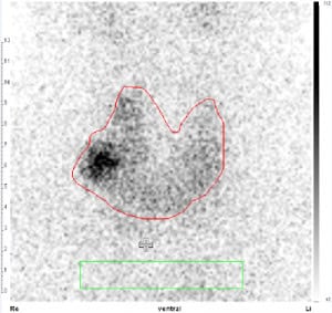 Autonomes Adenom und disseminierte Autonomien vor und nach Radiojodtherapie (Tc-Uptake 0,6 % bzw. 0,3 %).