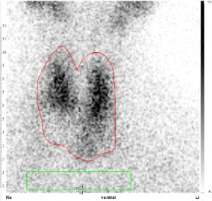 Kalter Knoten basal im linken Schilddrüsenlappen (Tc-Uptake 1,2 %).