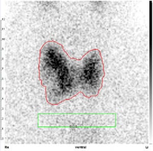 Kalter Knoten lateral im rechten Schilddrüsenlappen (Tc-Uptake 1,2 %).