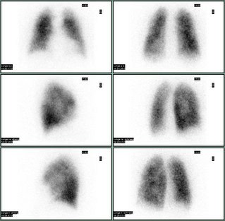 Lungenperfusionsszintigraphie mit Darstellung einer inhomogen Aktivitätsbelegung beider Lungenflügel infolge chronischer Bronchitis.