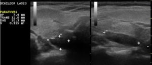 Sonographische Darstellung eines Nebenschilddrüsenadenoms am oberen Hinterrand des rechten Schilddrüsenlappens.
