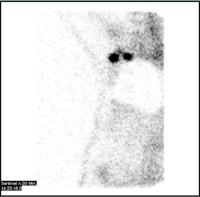 2 Sentinellymphknoten in der rechten Axilla bei Mamma-Carcinom rechts.