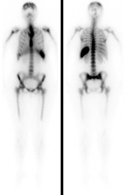 Normale Knochenmarkszintigraphie bei einer erwachsenen Frau mit Scintimmun™.