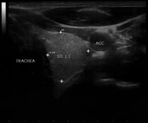 Normalbefund (abgebildet ist ein homogener und echonormaler, d.h. wesentlich hellerer linker Schilddrüsenlappen im Vergleich zur vorderen Halsmuskulatur).