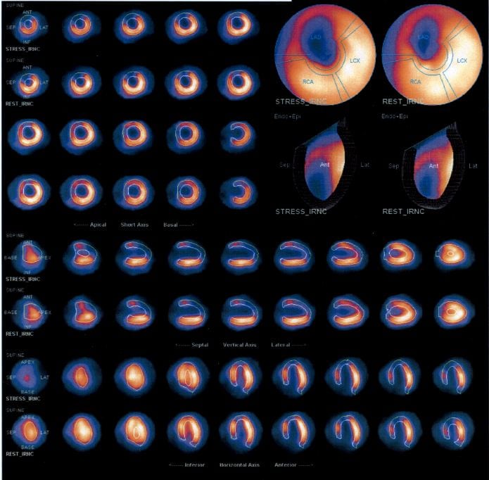 Vorderwandnarbe (fehlende Darstellung eines großen Areals in der Vorderwand, im vorderwandnahen Septum einschließlich Herzspitze infolge proximalem RIVA-Verschluss).