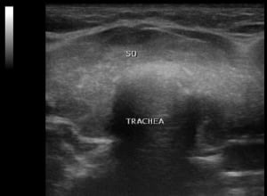 Autoimmunthyreoiditis Hashimoto (Querschnitt durch beide Schilddrüsenlappen mit einem echoärmeren und inhomogen Schallmuster sowie gering gesteigerter Perfusion bei hypothyreoter Stoffwechsellage, TSH 10,1 mU/l).