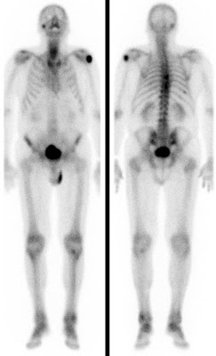 Multiple Skelettmetastasen eines Prostata-Carcinoms (80 J.). (Ganzkörperaufnahmen bei Erstdiagnose und nach 6-monatiger Bisphosphonat-Behandlung sowie Androgendeprivation.)