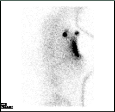 2 Sentinellymphknoten in der rechten Axilla bei Mamma-Carcinom rechts.