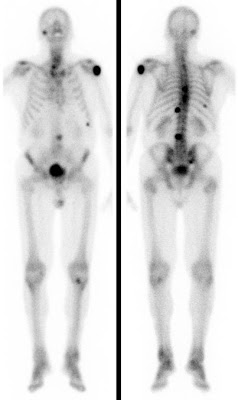 Multiple Skelettmetastasen eines Prostata-Carcinoms (80 J.). (Ganzkörperaufnahmen bei Erstdiagnose und nach 6-monatiger Bisphosphonat-Behandlung sowie Androgendeprivation.)