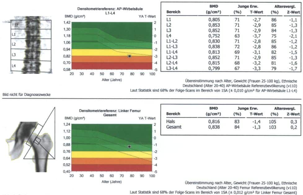 Postmenopausale Osteoporose bei 78-jähriger Frau mit einem T-Wert zwischen L2-L4 von -3,2.
