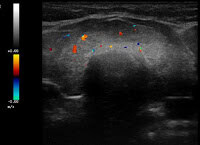 Autoimmunthyreoiditis Hashimoto (Querschnitt durch beide Schilddrüsenlappen mit einem echoärmeren und inhomogen Schallmuster sowie gering gesteigerter Perfusion bei hypothyreoter Stoffwechsellage, TSH 10,1 mU/l).