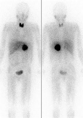 Im vorliegenden Beispiel ist bei einem Patienten mit M. Parkinson das normalerweise gut sichtbare Herz nicht mehr abzugrenzen.