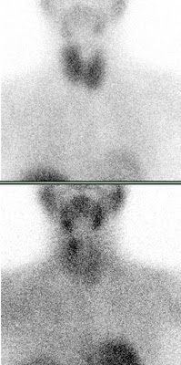 Szintigraphische Darstellung dieses Nebenschilddrüsenadenoms am oberen Hinterrand des rechten Schilddrüsenlappens. (Auf der Aufnahme nach 10 min. findet sich das MIBI noch in der Schilddrüse und in den Nebenschilddrüsen. Nach 2 Stunden hingegen ist die Markierungssubstanz weitgehend aus der Schilddrüse sowie den gesunden Nebenschilddrüsen entwichen, wird aber im Nebenschilddrüsenadenom noch deutlich gespeichert.)