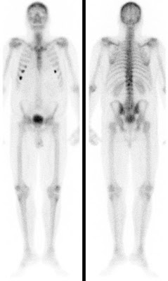 Multiple Rippenfrakturen bei Osteoporose/Osteomalazie eines 60-jährigen Mannes infolge Hypogonadismus und sekundärem Hyperparathyreoidismus infolge Vitamin D-Mangel.