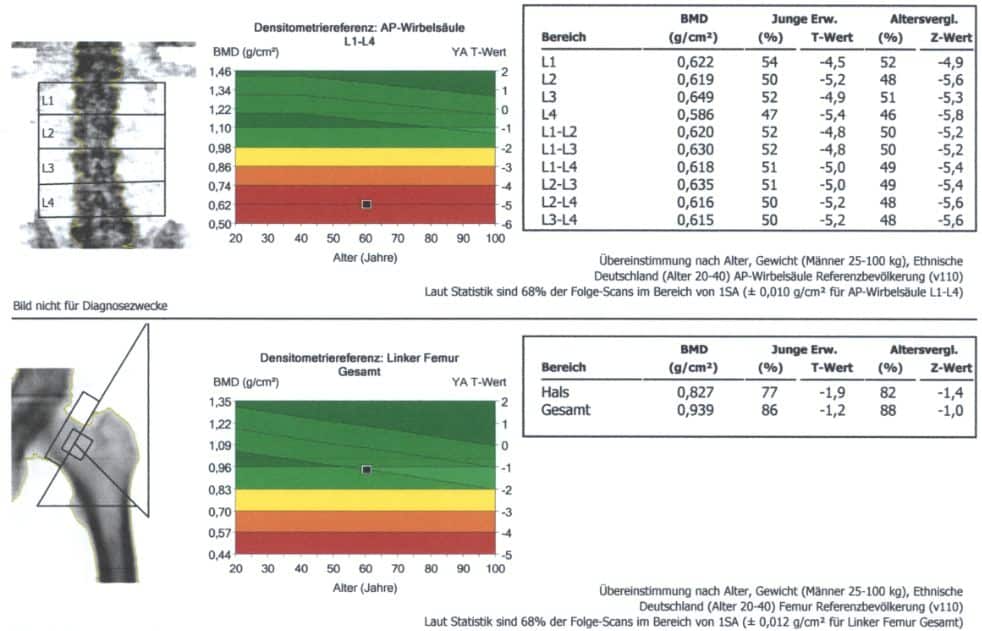 Stark erniedrigte Knochendichte infolge Hypogonadismus und sekundärem Hyperparathyreoidismus infolge Vitamin D-Mangel bei einem 60-jährigen Mann