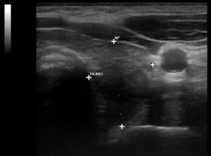Autoimmunthyreoiditis Hashimoto (Querschnitt durch den linken Schilddrüsenlappen mit einem deutlich echoarmen Schallmuster – die Schilddrüse hat nahezu die gleiche Echogenität wie die vordere Halsmuskulatur).