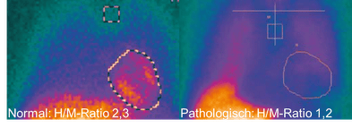 (ADMIRE-HF-Studie – AdreViewR Myocardial Imaging for Risk Evaluation in Heart Failure)
