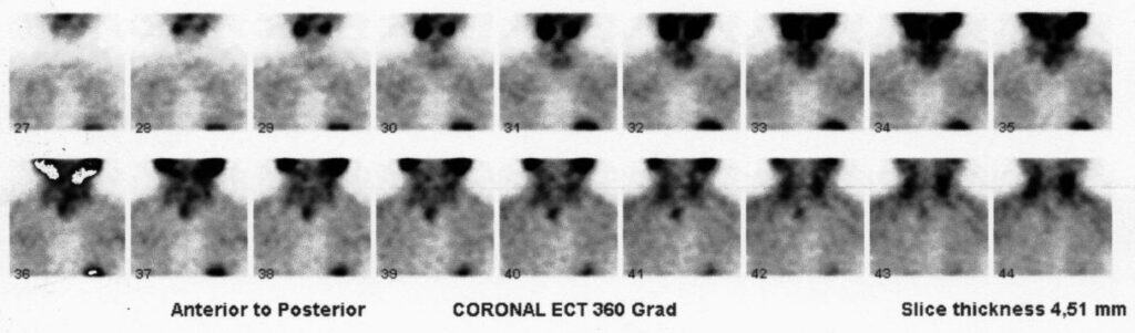 Szintigraphische Darstellung eines retrosternal gelegenes Nebenschilddrüsenadenoms.