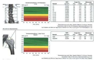 Multiple Rippenfrakturen bei Osteoporose/Osteomalazie eines 60-jährigen Mannes infolge Hypogonadismus und sekundärem Hyperparathyreoidismus infolge Vitamin D-Mangel.