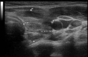 Autoimmunthyreoiditis Hashimoto (Querschnitt durch den linken Schilddrüsenlappen mit einem deutlich echoarmen und sehr inhomogenen Schallmuster).