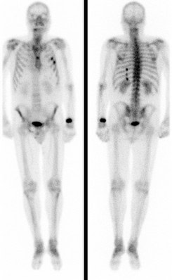 Multiple Rippenfrakturen und Fraktur des linken Radiusköpfchens bei einem 61-jährigen Mann nach einem Fahrradsturz.