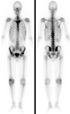 M. Bechterew / Spondylitis ankylosans mit stark vermehrtem Knochenumbau im Brustbein, den Iliosakralgelenken (Sakroileitis) sowie im rechten Kniegelenk.
