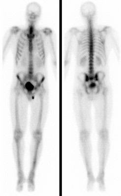 M. Bechterew mit Mehranreichung in der Wirbelsäule, beiden Iliosakralgelenken, Sternum und Sternoclaviculargelenken.