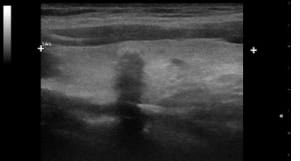 Längsschnitt des linken Schilddrüsenlappens mit 6 mm großem papillärem Schilddrüsencarcinom (randständig weitgehend verkalkt) sowie Quer- und Längsschnitt einer zugehörigen 2 ml großen Metastase linksseitig submandibulär.