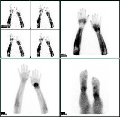 Rheumatoide Arthritis / chronische Polyarthritis u.a. mit deutlicher Entzündung des linken Handgelenks.