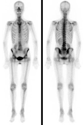Nebenbefunde Senkniere links und Falxmeningeom mittig hoch über der Stirn bei einer 60-jährigen Frau.