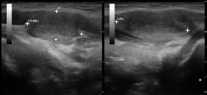 Längsschnitt des linken Schilddrüsenlappens mit 6 mm großem papillärem Schilddrüsencarcinom (randständig weitgehend verkalkt) sowie Quer- und Längsschnitt einer zugehörigen 2 ml großen Metastase linksseitig submandibulär.