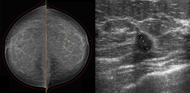 Biopsie (Gewebeprobe)