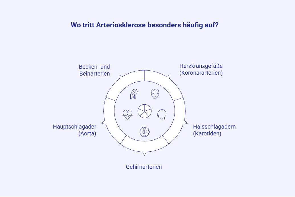 tritt-arteriosklerose-besonders-haeufig