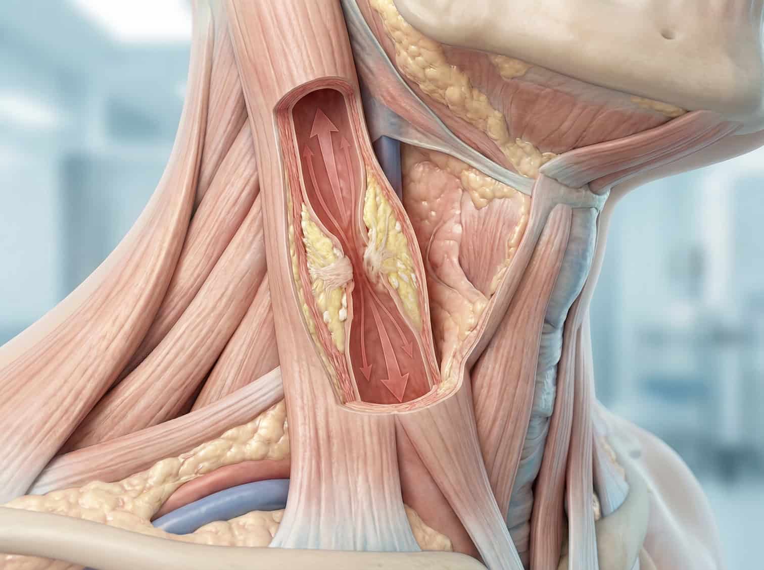 karotisstenose-halsschlagader-verengung-ursachen-risikofaktoren-symptome-diagnostik-behandlung
