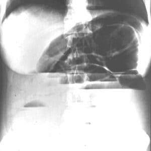 Ileus