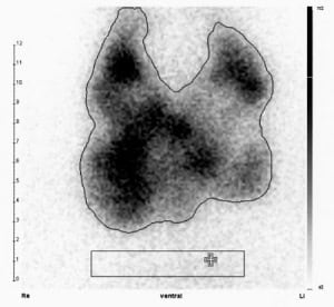 Hyperthyreose infolge multifokaler Autonomie in großer Knotenstruma (Tc-Uptake 2,1 %).