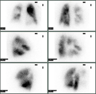 Lungenperfusionsszintigraphie mit Darstellung eines weitgehenden Perfusionsausfalls des rechten Lungenflügels infolge ausgedehnter Lungenembolien.