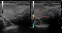 Sonographische Darstellung eines Nebenschilddrüsenadenoms am oberen Hinterrand des rechten Schilddrüsenlappens.