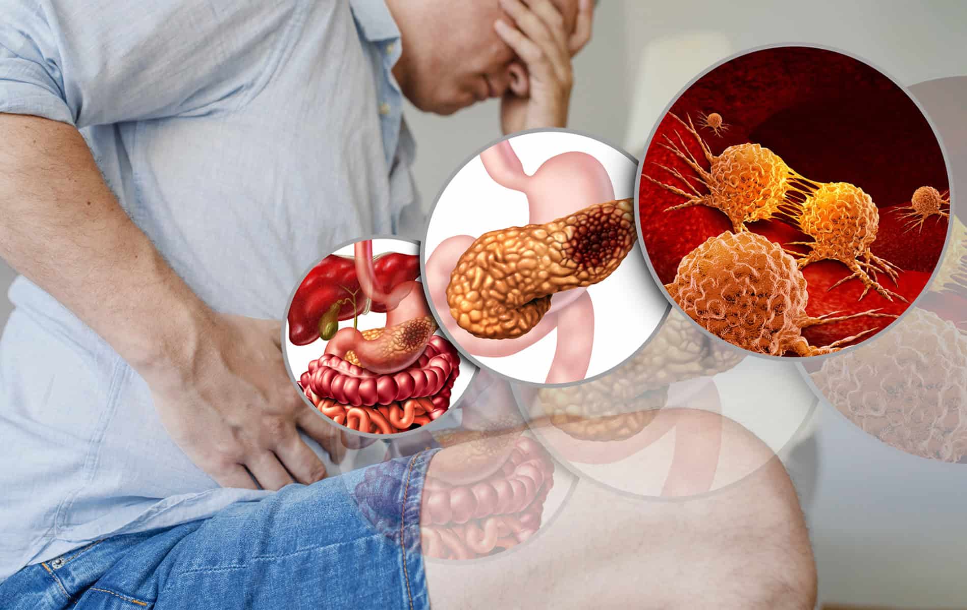 pankreaskarzinom
